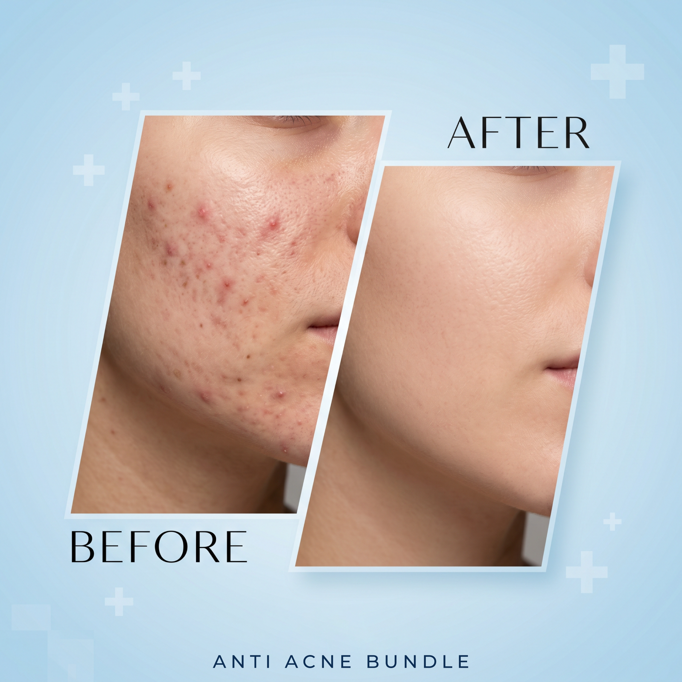 ANTI ACNE BUNDLE