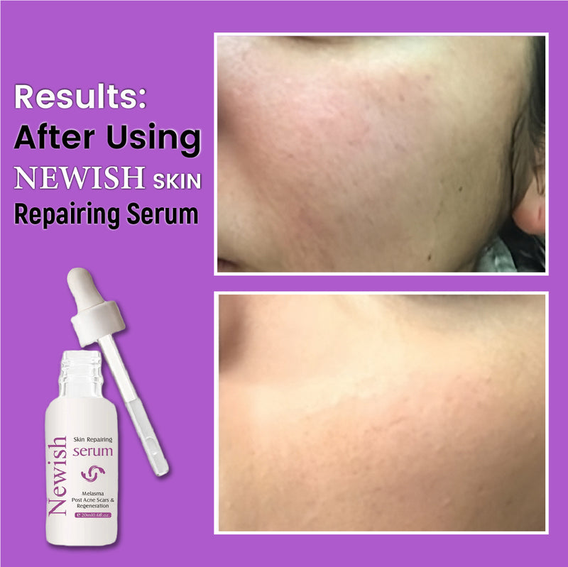 Newish Skin Repairing Serum – For Acne Scars