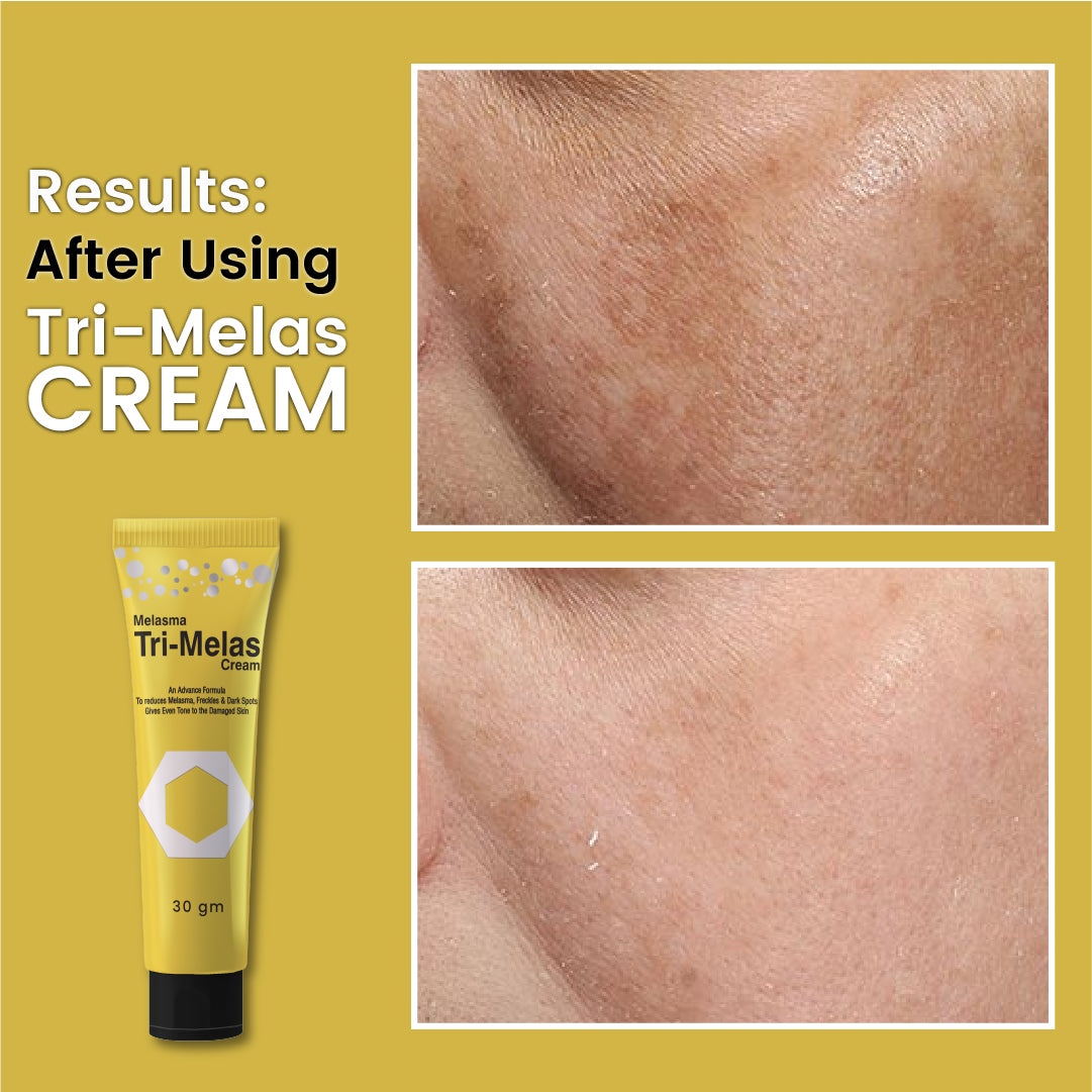 Cream for pigmentation