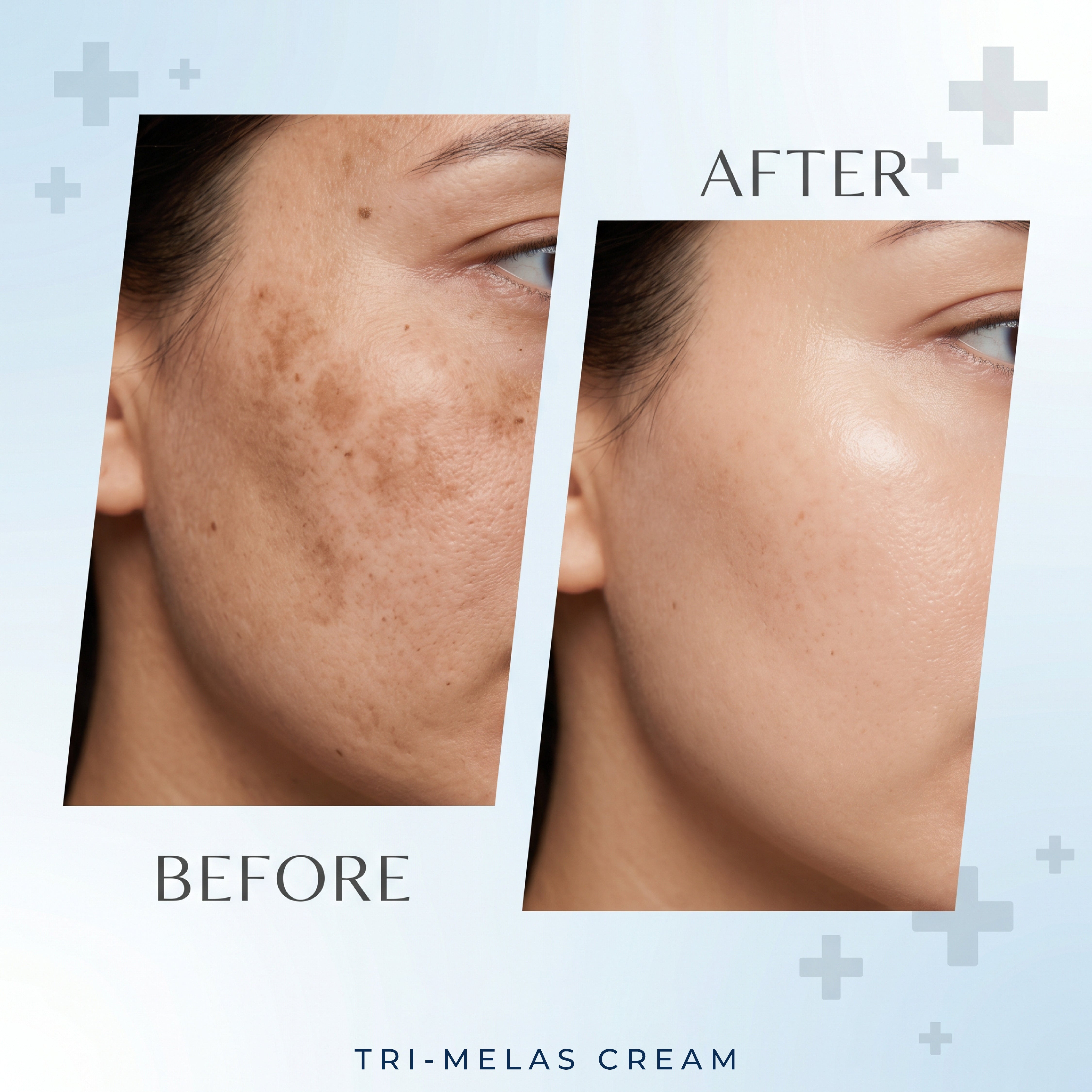 Tri Melas Cream - Best Melasma Cream